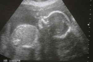 Ultrasound of D