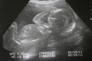 Profile Ultrasound of D Profile Ultrasound of D